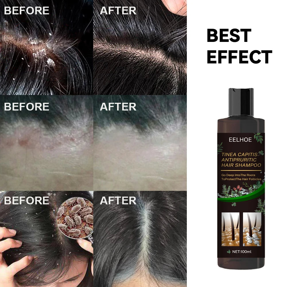 EELHOE Hair Cleaning Shampoo Anti Dandruff Remove Mites Relieve Itching Oil Control Scalp Cleaning Refreshing Hair Shampoo