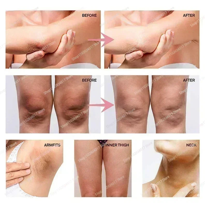 HOT~Whitening Cream Private Parts Underarm Bleaching Serum Whiten Butt Knee Brighten Inner Thigh Intimate Parts Dark Remove Mela