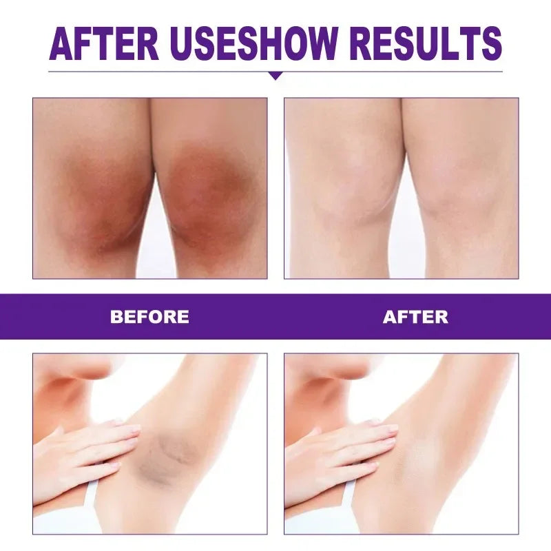 Skin Whitening Cream Private Tender White Lips Joint Melanin Removal Maintenance Armpit Private Parts Underarm Bleaching Serum