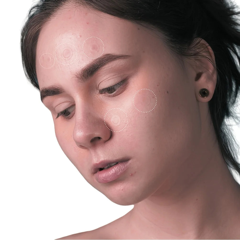 36pcs Hydrocolloid Acne Patches - Absorb Pus & Oil, Reduce Redness, Invisible Fit for All-Day Wear.