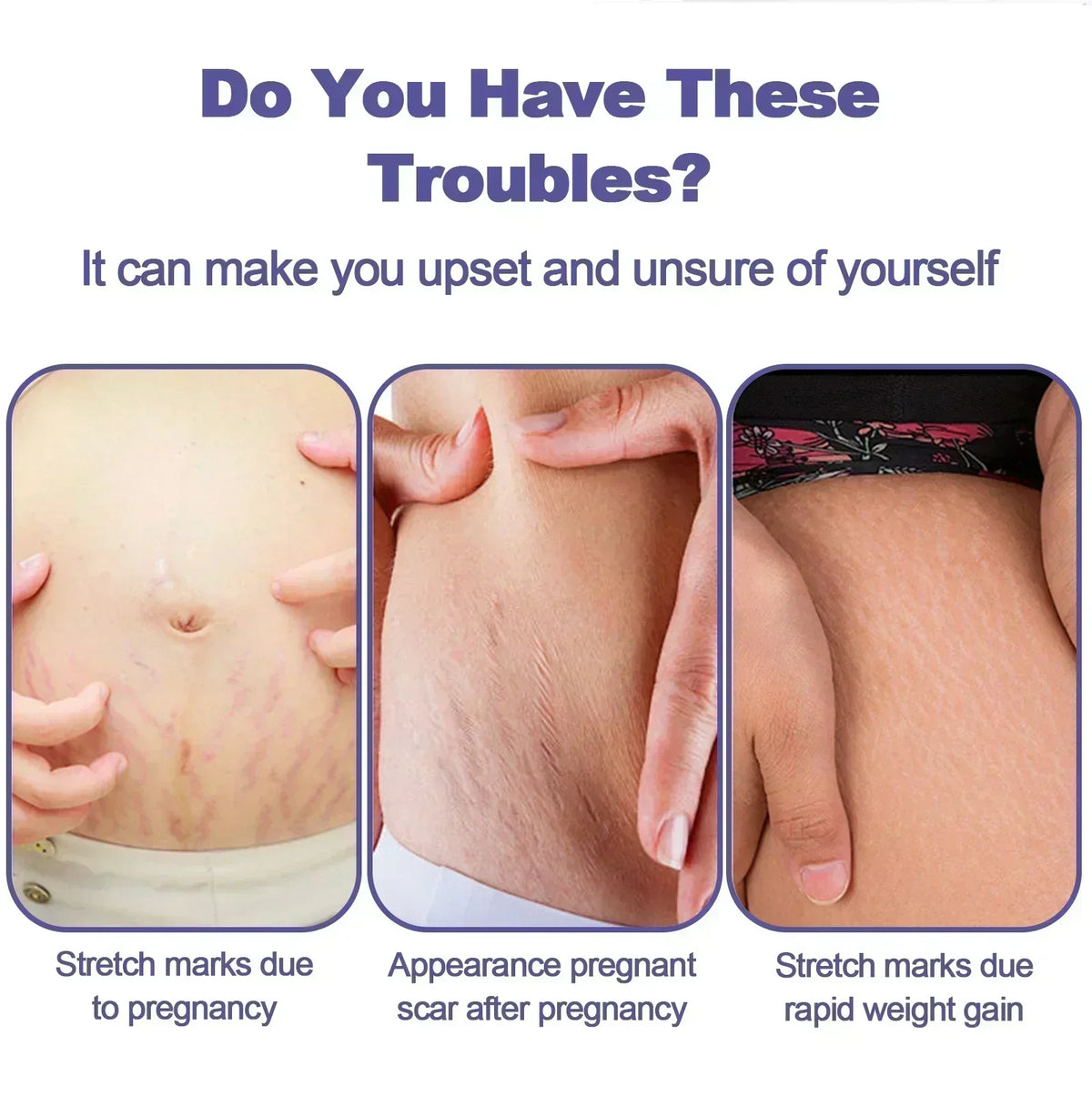 Stretch Mark Vanishing Cream Effective treatment Remove Body Buttock Breast Marks Repair Maternity Loose Firming Skin body Care