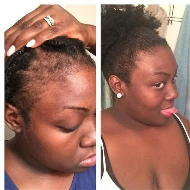 100ML Hair Shampoo For Fast Hair Growth Rosemary Onion Shampoo 30ML Spray Anti Hair Loss Effective Within 7 Day Hair Growth