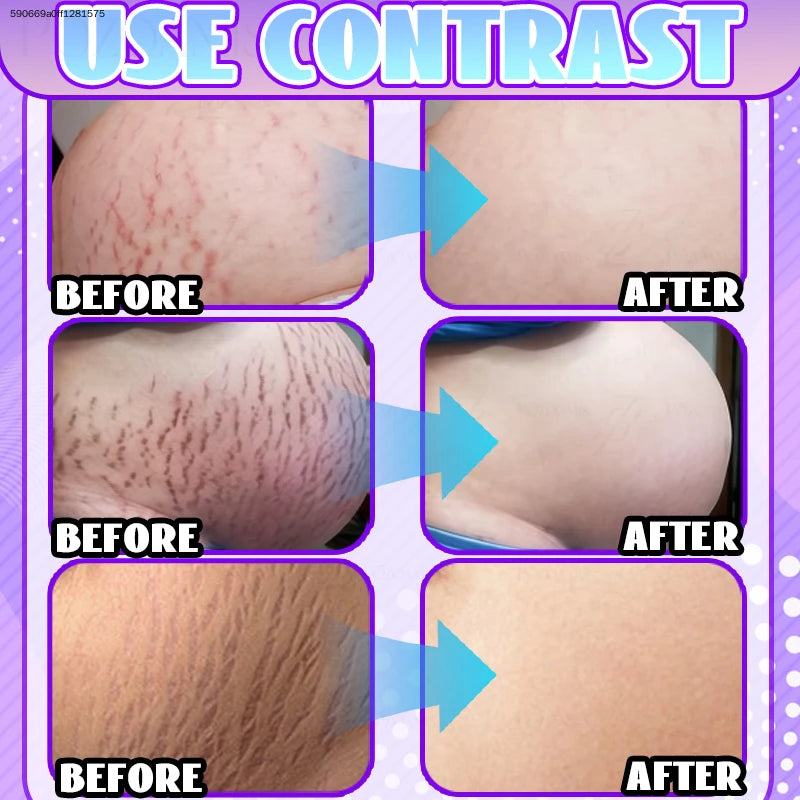 Intensive Stretch Mark Corrector Body Oil for Pregnancy & Post-Baby, C-Section Scar Fader & Anti-Sagging Firming Therapy