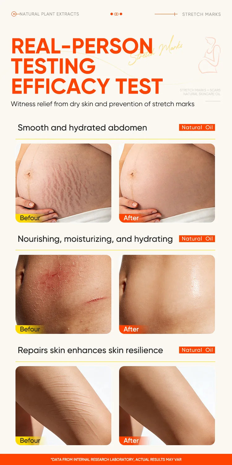 150ml Vitamin E Skin Care Oil Remove Pregnancy Stretch Marks Postpartum Care Elastic Skin Firming Collagen Body Care Oil