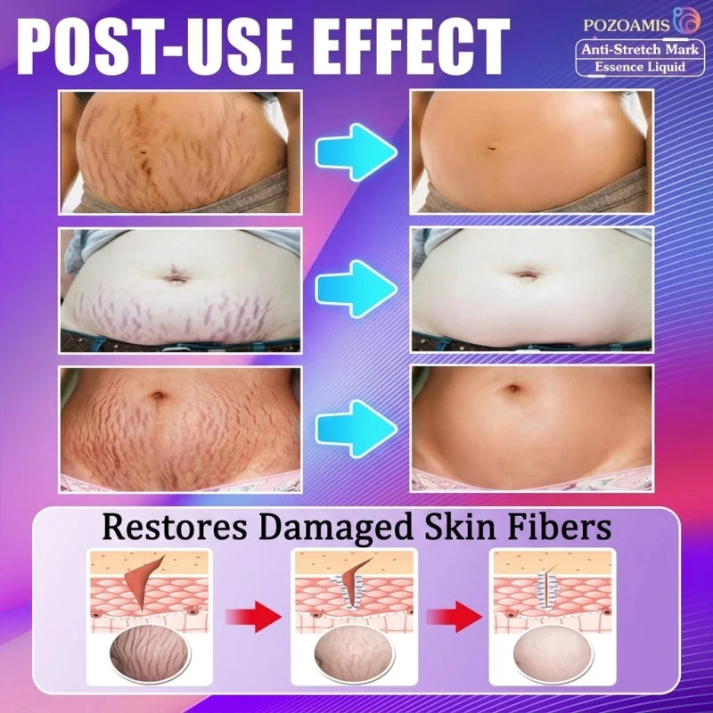 Intensive Stretch Mark Corrector Body Oil for Pregnancy & Post-Baby, C-Section Scar Fader & Anti-Sagging Firming Therapy