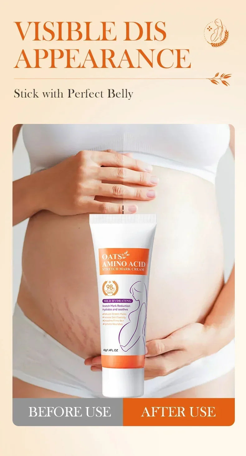 Powerful Stretch Marks Remover Pregnancy Cream Light Lines Removal Postpartum Obesity