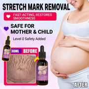 Intensive Stretch Mark Corrector Body Oil for Pregnancy & Post-Baby, C-Section Scar Fader & Anti-Sagging Firming Therapy
