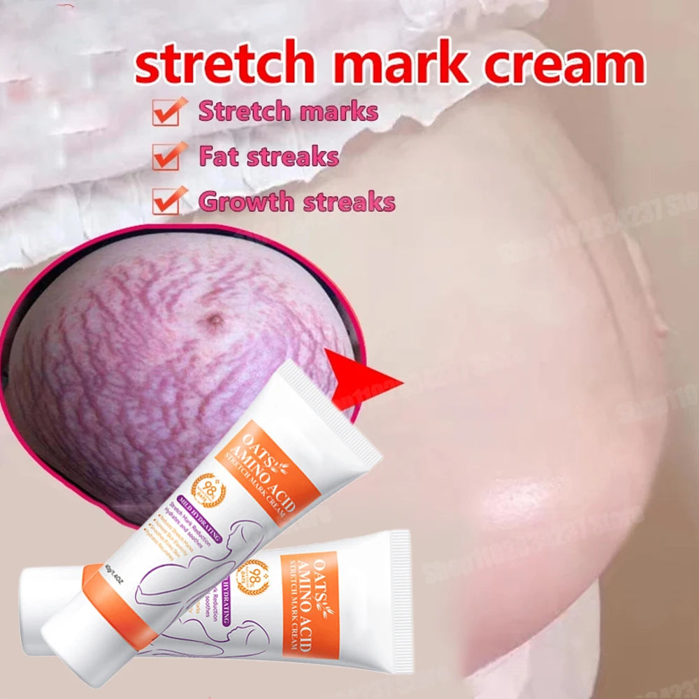 Powerful Stretch Marks Remover Pregnancy Cream Light Lines Removal Postpartum Obesity