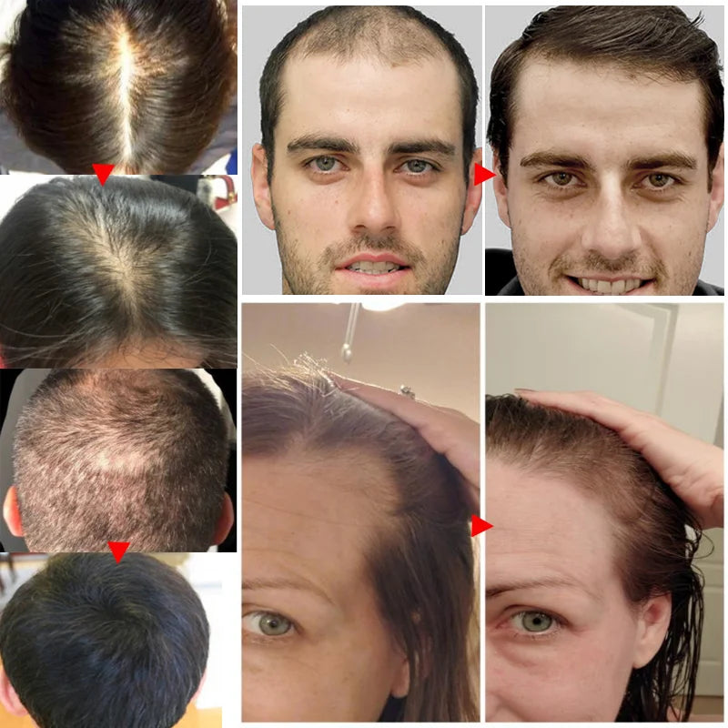 Ginger Hair Growth Essential Oil Natural Anti Hair Loss Products Fast Grow Prevent Baldness Treatment Germinal Liquid Men Women