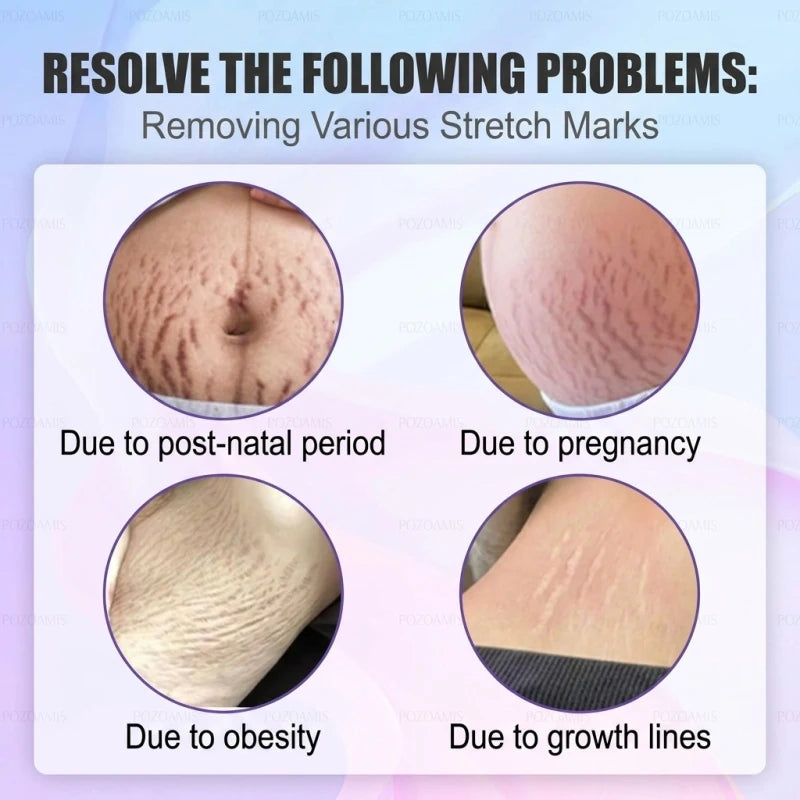 Intensive Stretch Mark Corrector Body Oil for Pregnancy & Post-Baby, C-Section Scar Fader & Anti-Sagging Firming Therapy