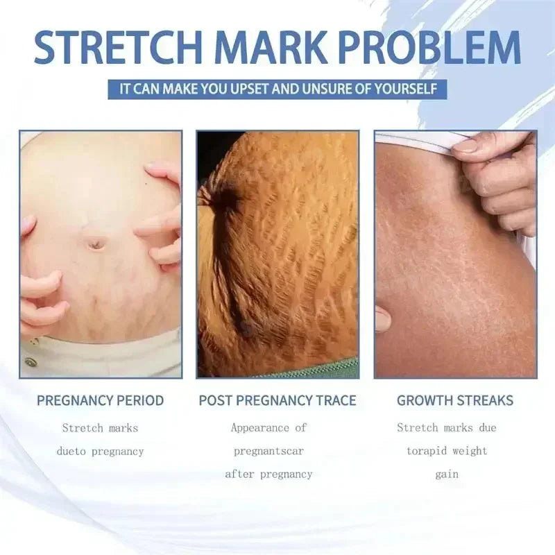 Powerful Stretch Marks Remover Pregnancy Cream Light Lines Removal Postpartum Obesity