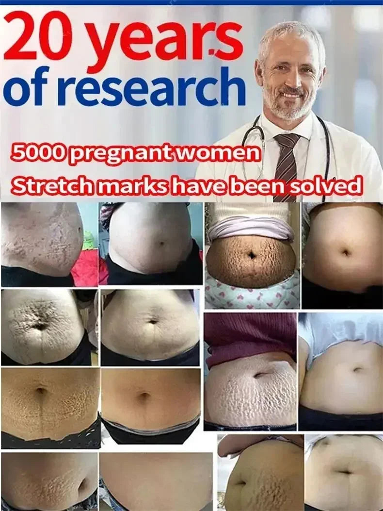 Powerful Stretch Marks Remover Pregnancy Cream Light Lines Removal Postpartum Obesity