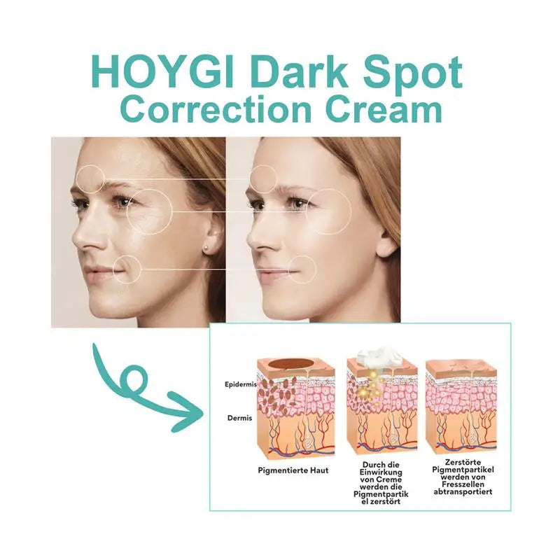 Powerful Spot-removing Whiten Cream Brighten Skin Fast Eliminates Melanin Pigmentation Melasma Dark Spots Moisturize Beauty Gel