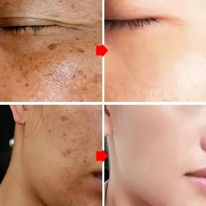 Powerful Dark Spots Remover Whitening Serum Face Freckle Melanin Correcting Anti Pigmentation Brighten Skin Beauty Care Products