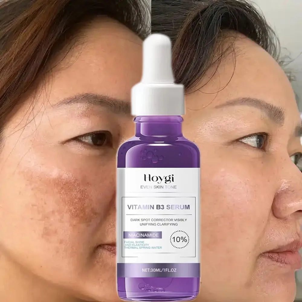 Powerful Dark Spots Remover Freckle Whitening Serum Melanin Correcting Anti Pigmentation Brighten Korean Day Night Facial Care