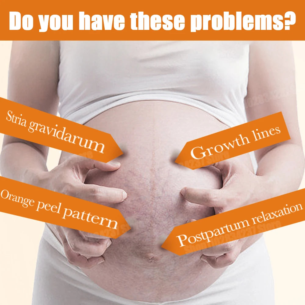 Powerful Stretch Marks Remover Pregnancy Cream Light Lines Removal Postpartum Obesity