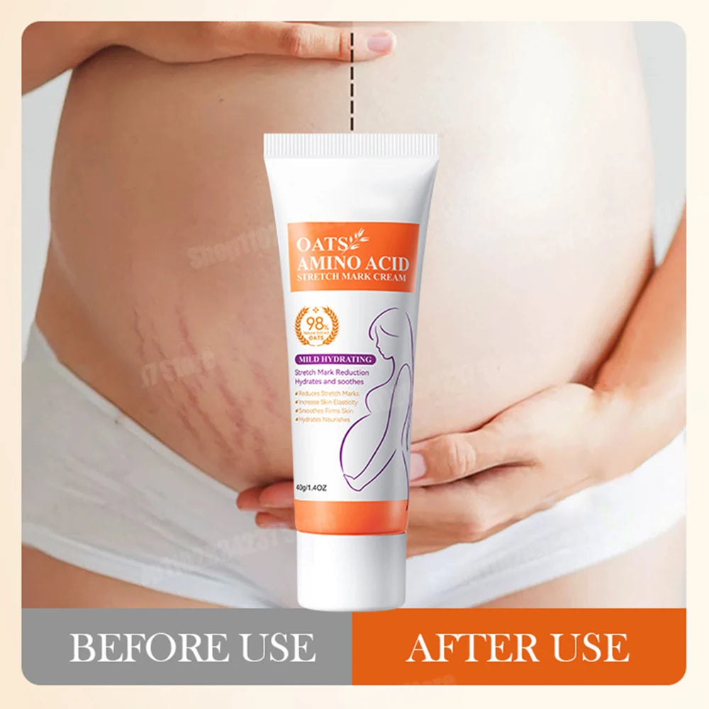 Powerful Stretch Marks Remover Pregnancy Cream Light Lines Removal Postpartum Obesity