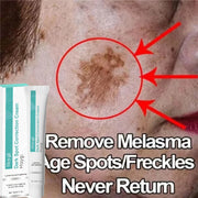 Powerful Spot-removing Whiten Cream Brighten Skin Fast Eliminates Melanin Pigmentation Melasma Dark Spots Moisturize Beauty Gel